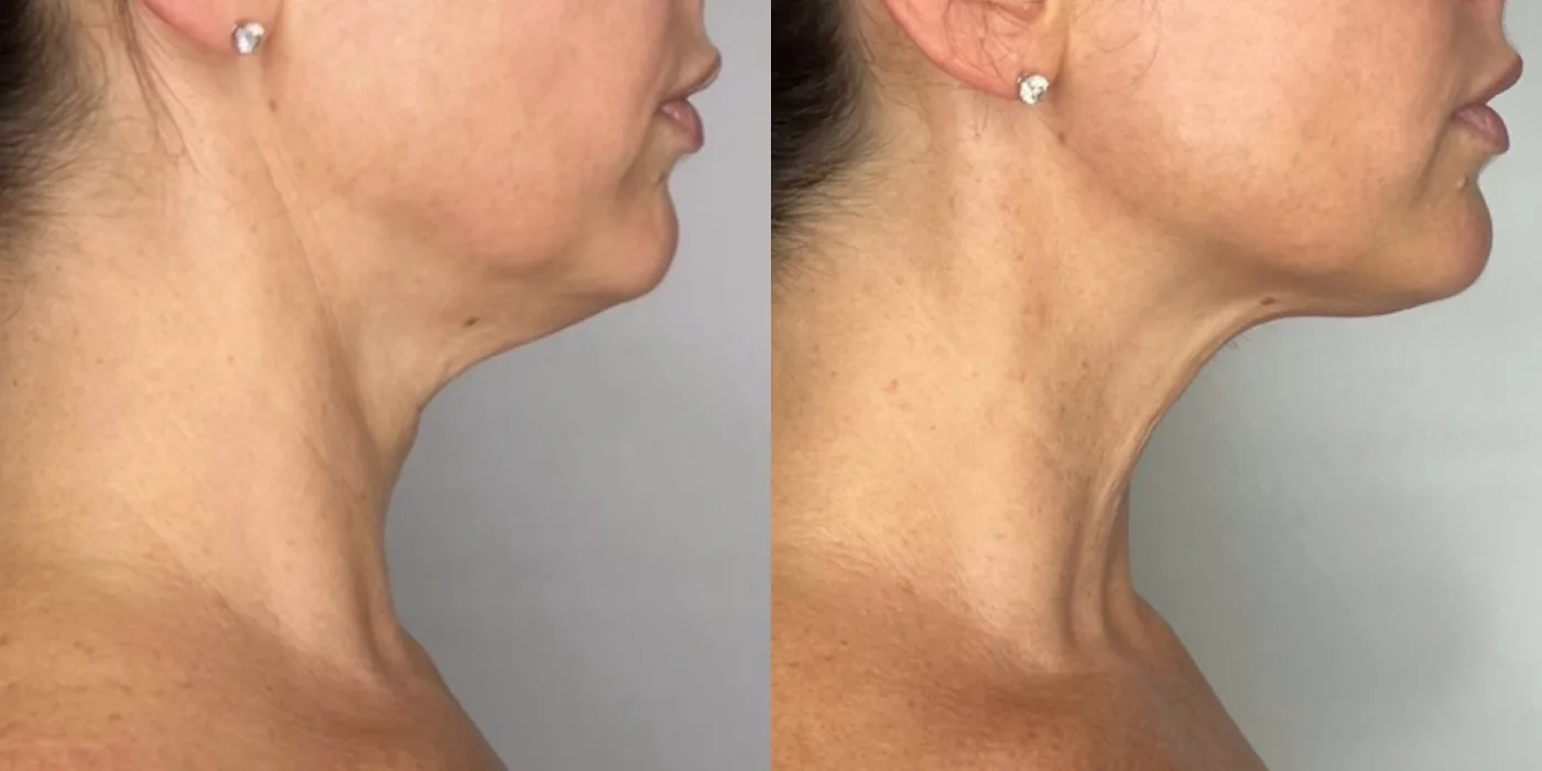Sofwave skin tightening before and after at Beauty Studio MediSpa, Shenfield