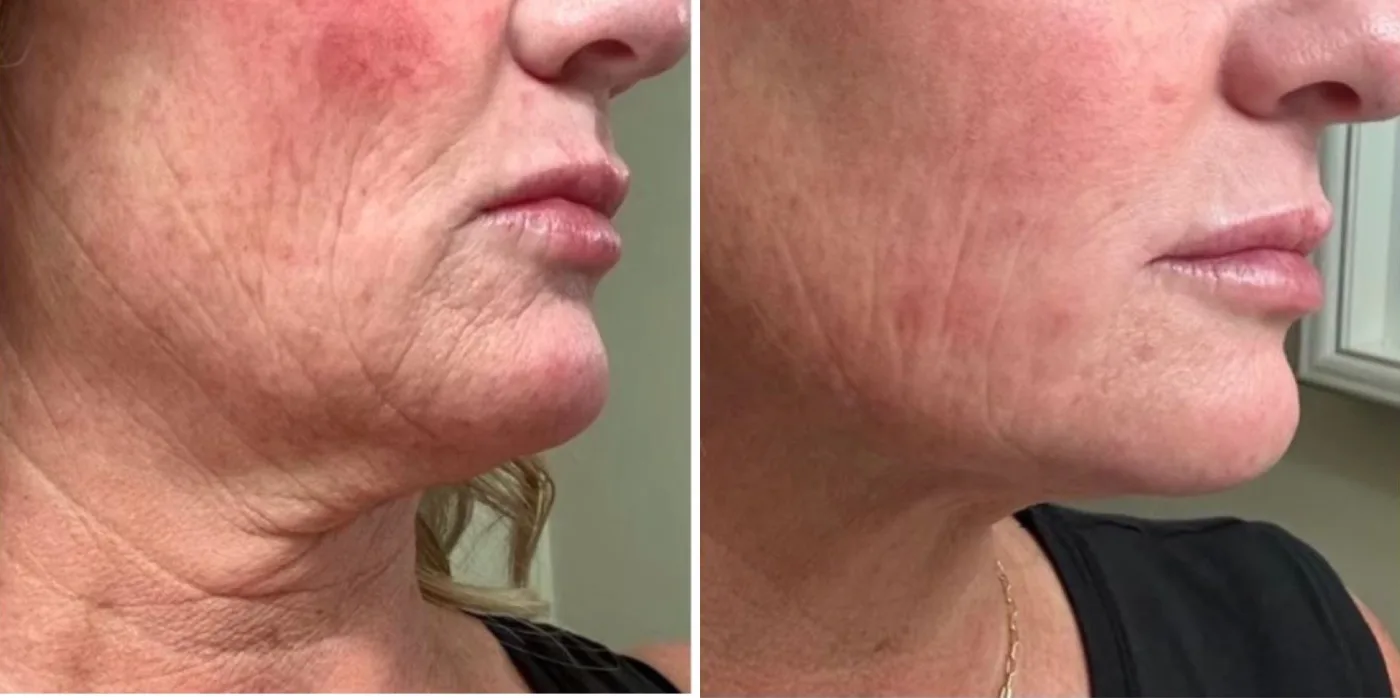 Sofwave skin tightening before and after at Beauty Studio MediSpa, Shenfield