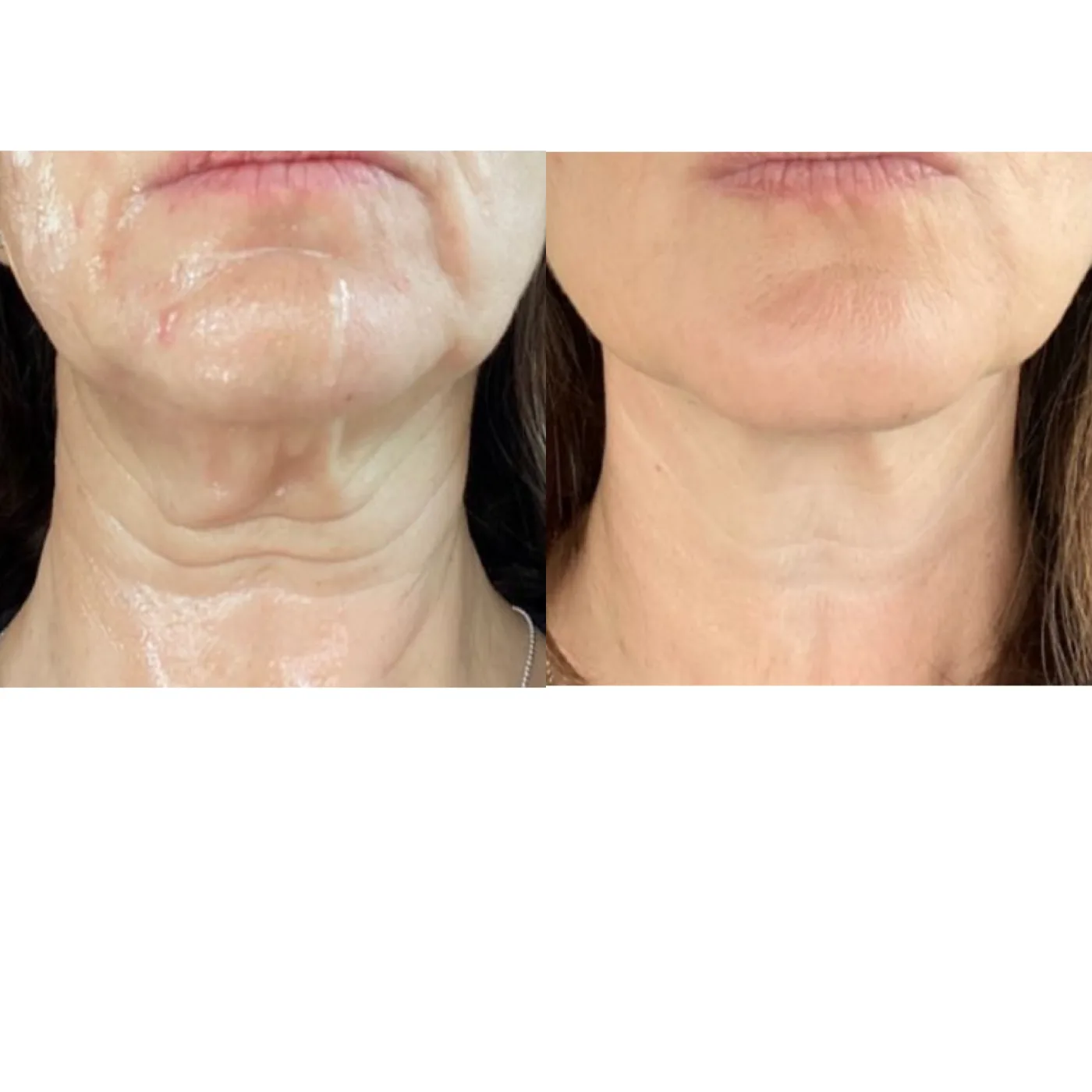 Sofwave skin tightening before and after at Beauty Studio MediSpa, Shenfield
