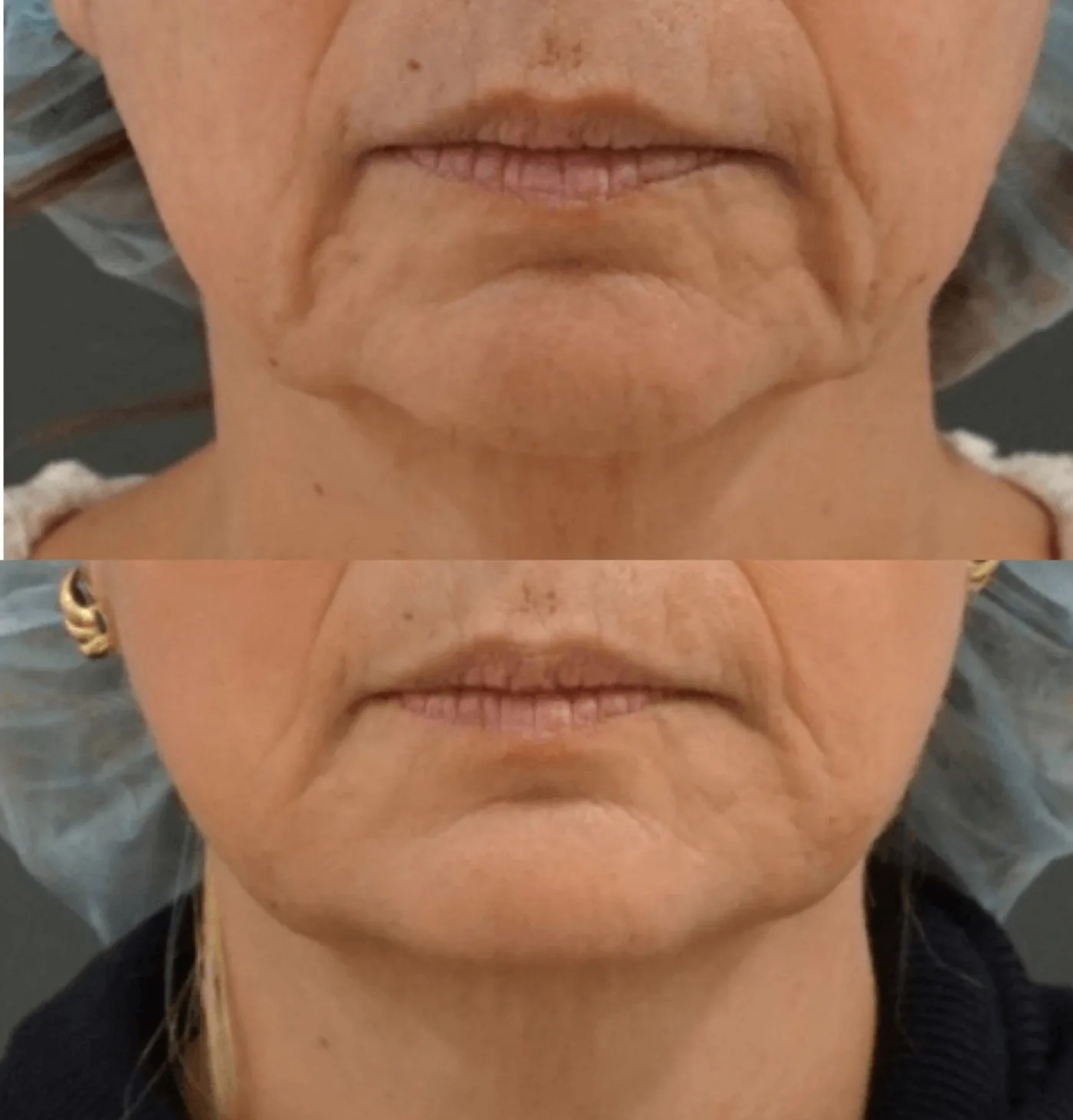 Sofwave skin tightening before and after at Beauty Studio MediSpa, Shenfield