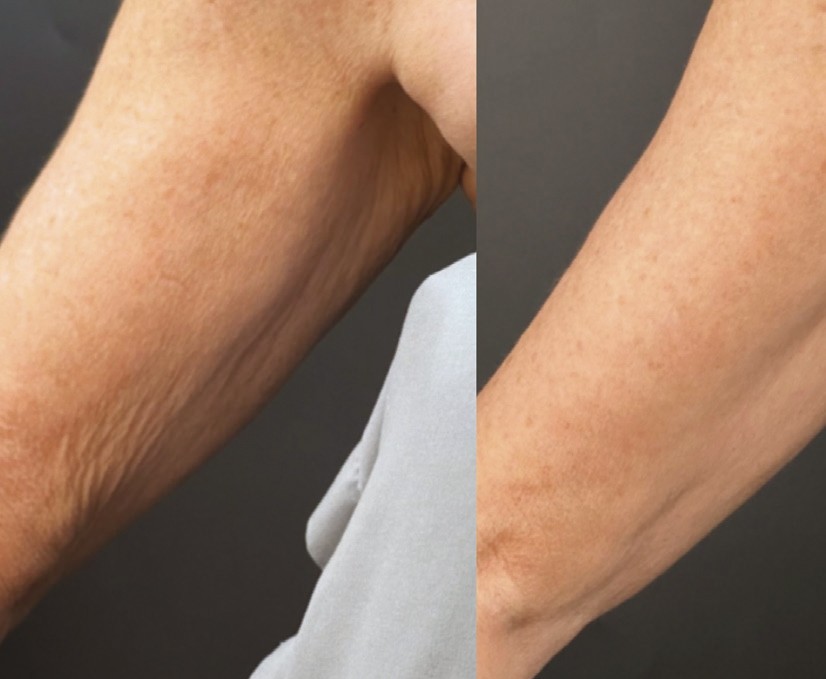 Sofwave for the Body before and after at Beauty Studio MediSpa, Shenfield