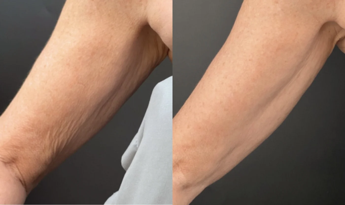 Sofwave Body before and after at Beauty Studio MediSpa, Shenfield