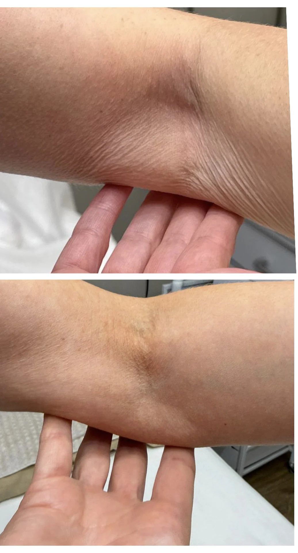 Sofwave Body before and after at Beauty Studio MediSpa, Shenfield