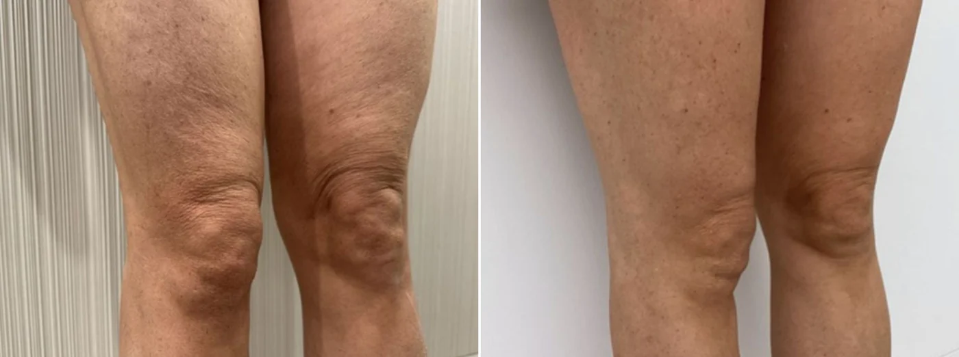 Sofwave Body before and after at Beauty Studio MediSpa, Shenfield