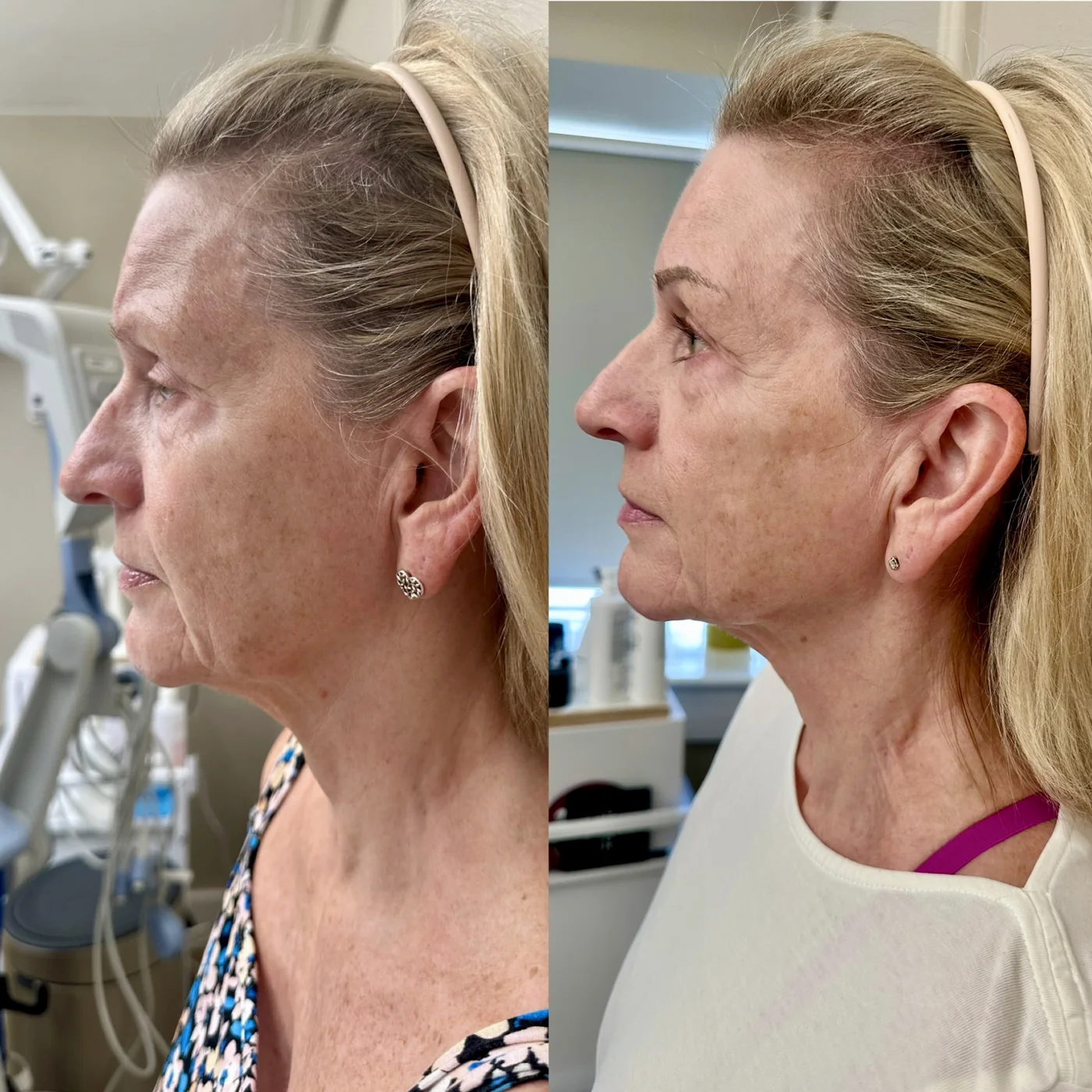 Transformation Collection facial lift before and after at Beauty Studio MediSpa, Shenfield