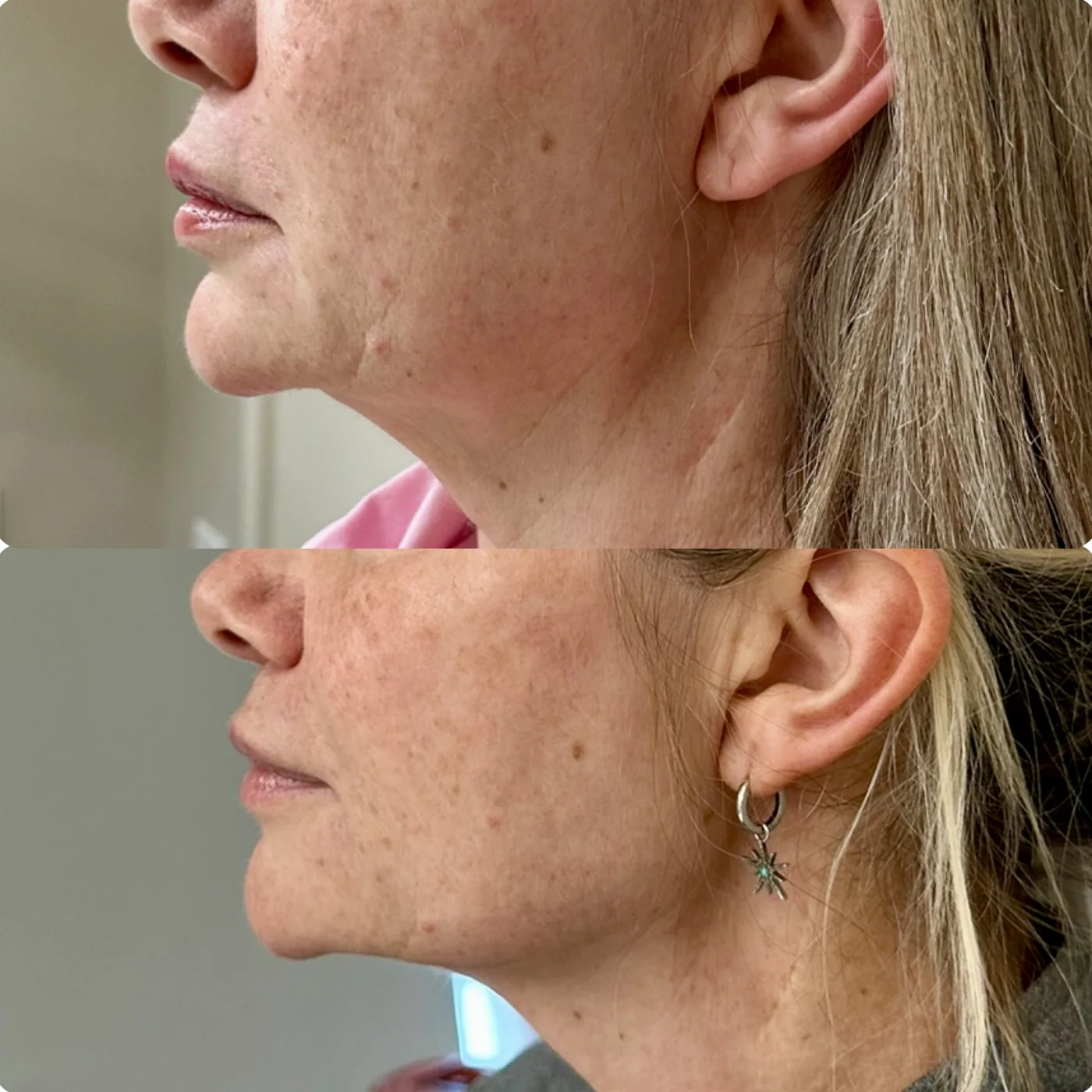 Transformation Collection facial lift before and after at Beauty Studio MediSpa, Shenfield