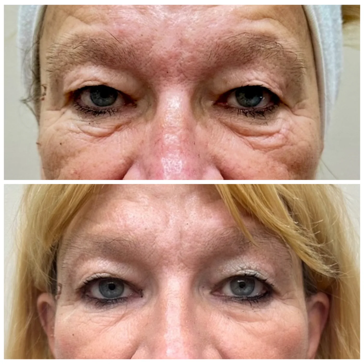 Transformation Collection facial lift before and after at Beauty Studio MediSpa, Shenfield
