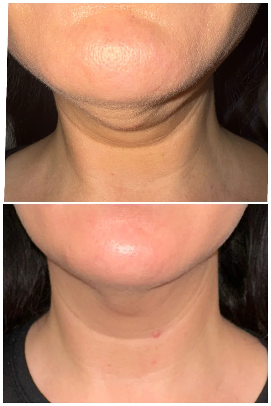 Transformation Collection facial lift before and after at Beauty Studio MediSpa, Shenfield
