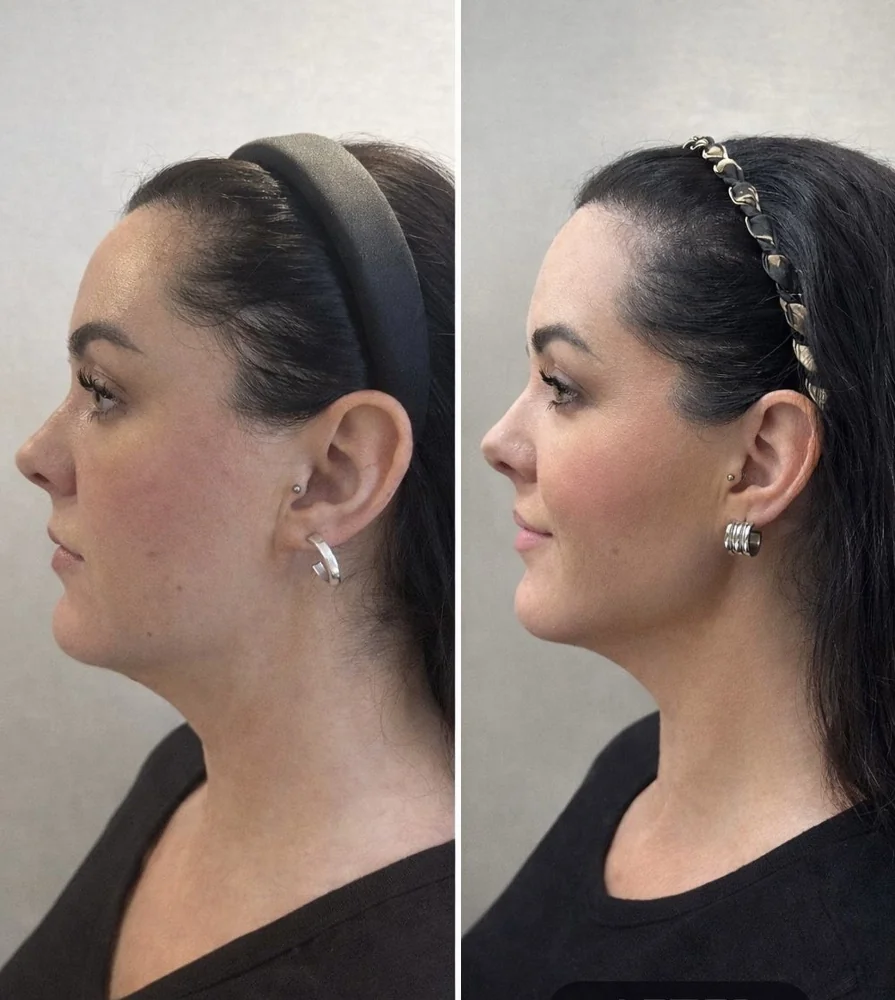 Transformation Collection before and after at Beauty Studio MediSpa, Shenfield