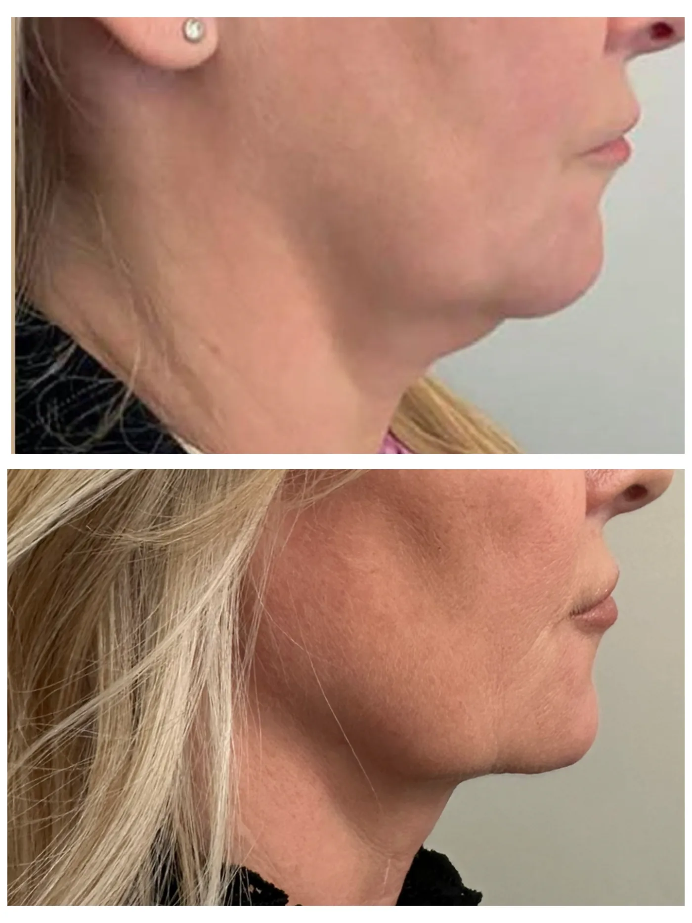 Skin lifting and tightening before and after at Beauty Studio MediSpa, Shenfield