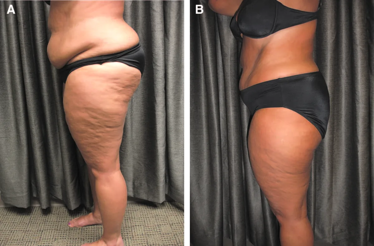 NEW Emerald Laser - Fat Reduction Launch OFFER on Now before and after