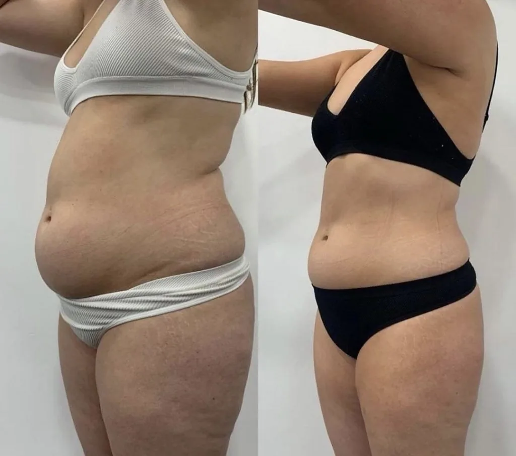 NEW Emerald Laser - Fat Reduction Launch OFFER on Now before and after