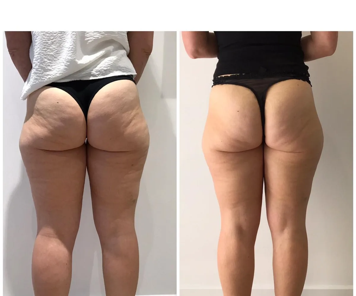NEW Emerald Laser - Fat Reduction Launch OFFER on Now