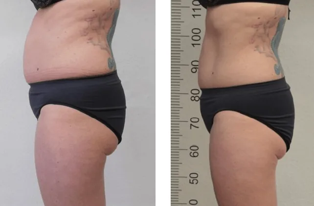 NEW Emerald Laser - Fat Reduction Launch OFFER on Now