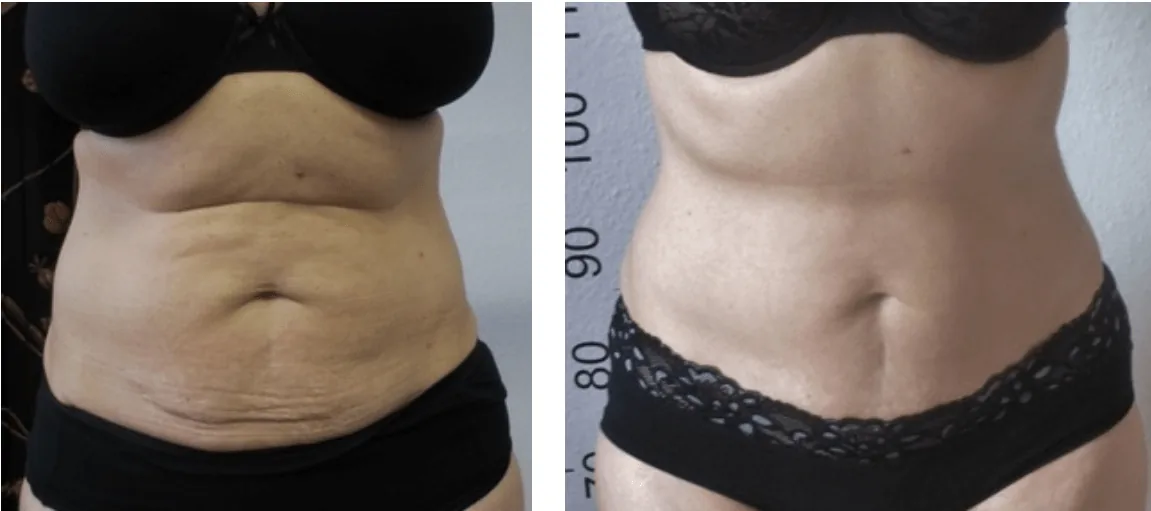 NEW Emerald Laser - Fat Reduction Launch OFFER on Now