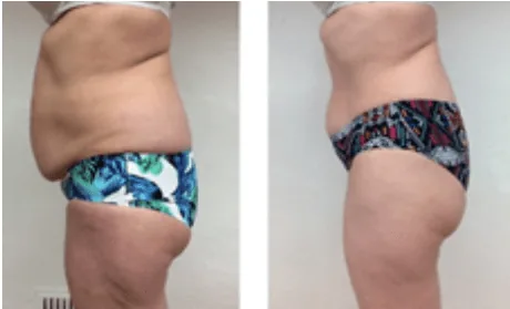 NEW Emerald Laser - Fat Reduction Launch OFFER on Now