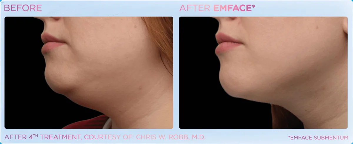 EMFACE for Double Chin & Jowls before and after