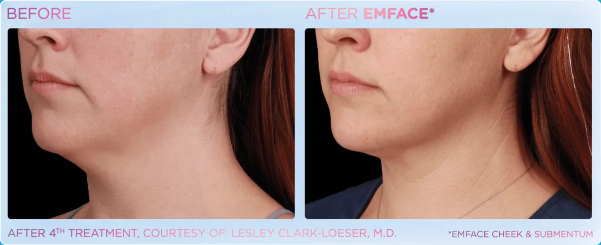 EMFACE for Double Chin & Jowls before and after