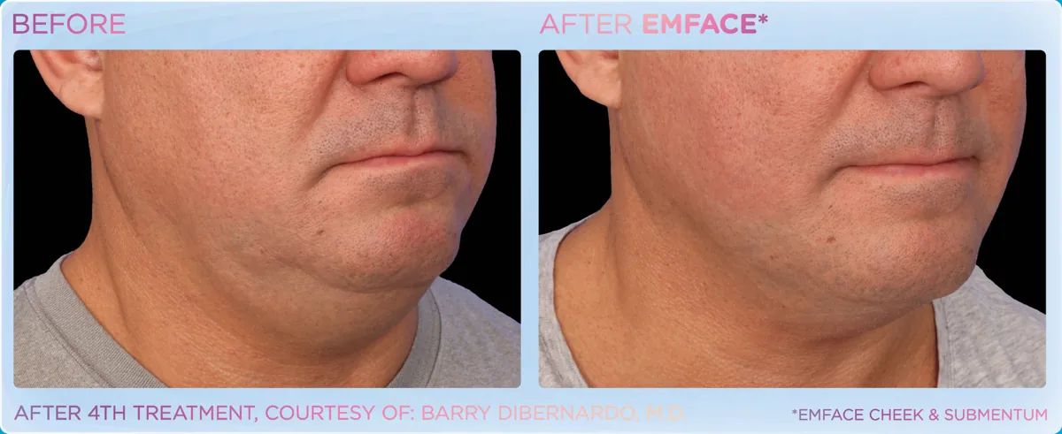 EMFACE for Double Chin & Jowls before and after