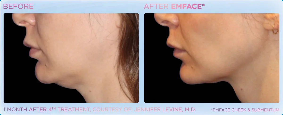 EMFACE for Double Chin & Jowls before and after