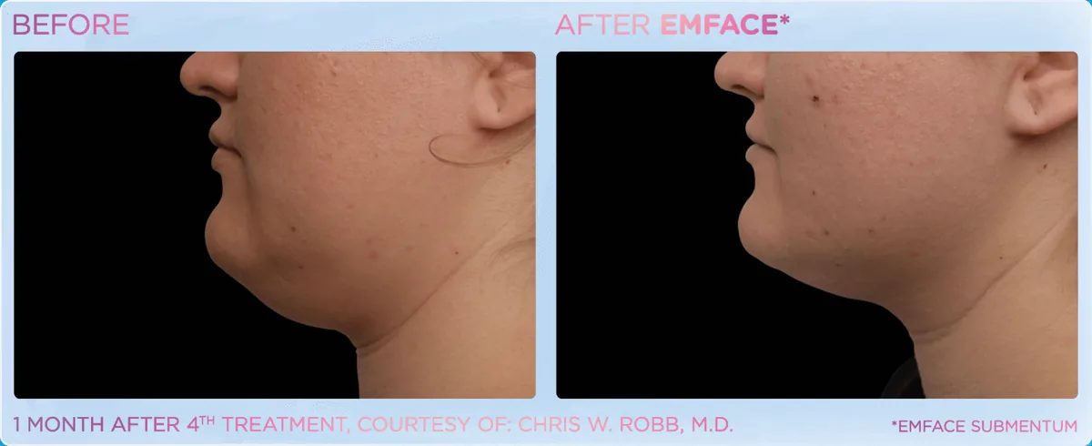 EMFACE for Double Chin & Jowls before and after