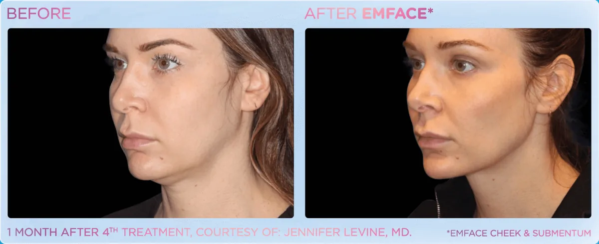 EMFACE for Double Chin & Jowls before and after