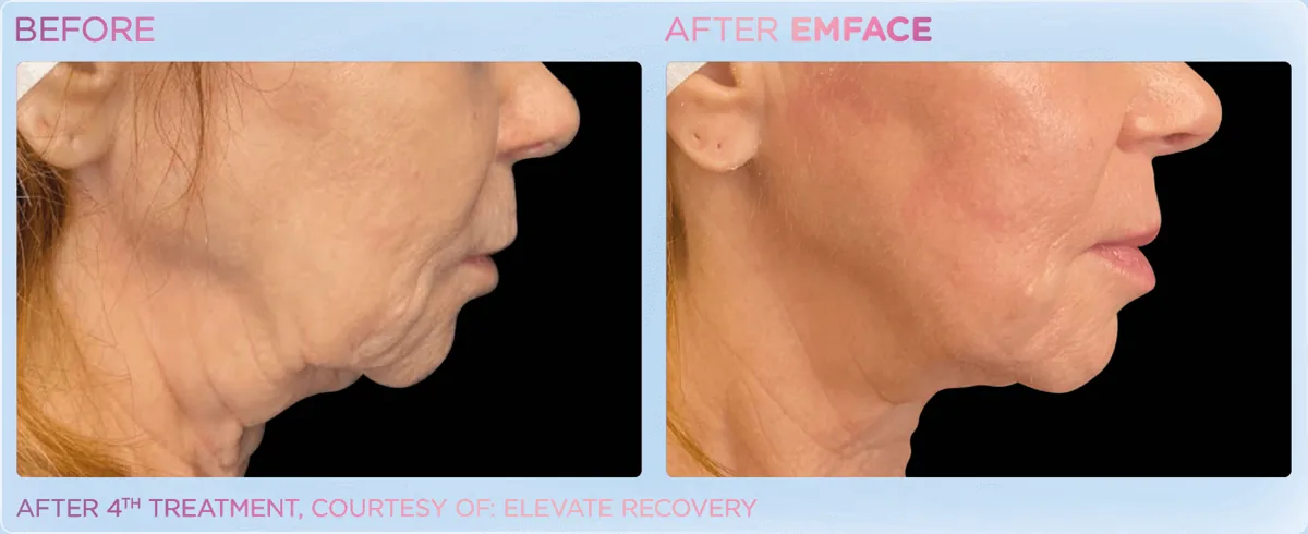 EMFACE for Double Chin & Jowls before and after
