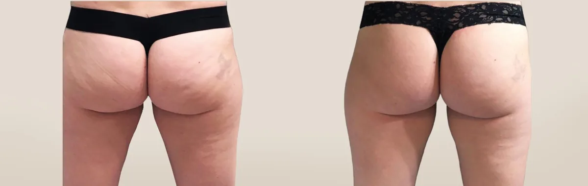 Next-generation Body Sculpting has arrived! before and after