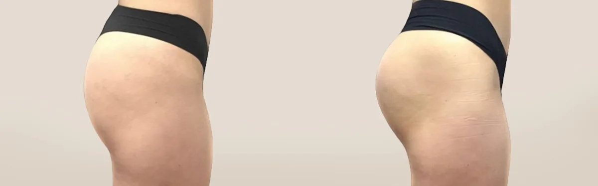 Next-generation Body Sculpting has arrived! before and after