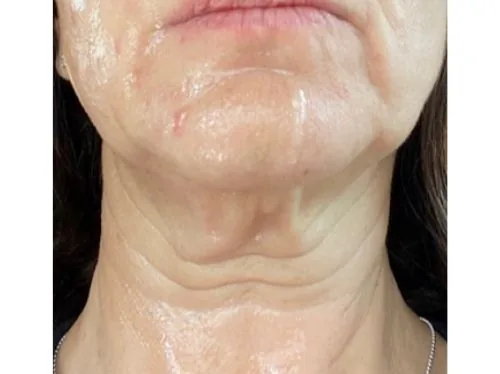 The Skin-Lifting Tech Everyone's Talking About...