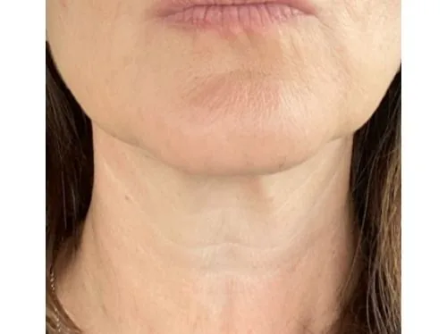 The Skin-Lifting Tech Everyone's Talking About...