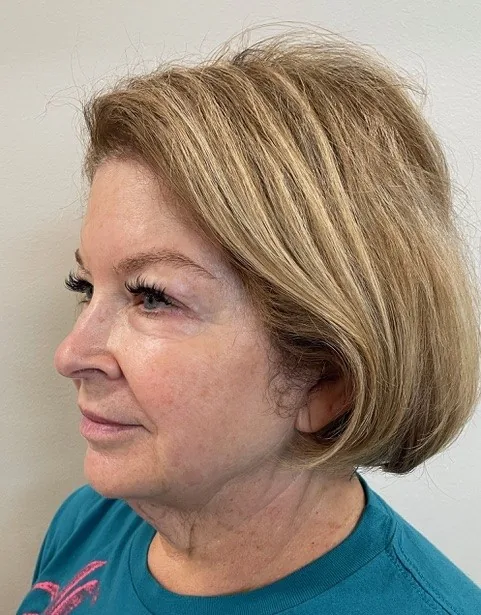 The Skin-Lifting Tech Everyone's Talking About... before and after