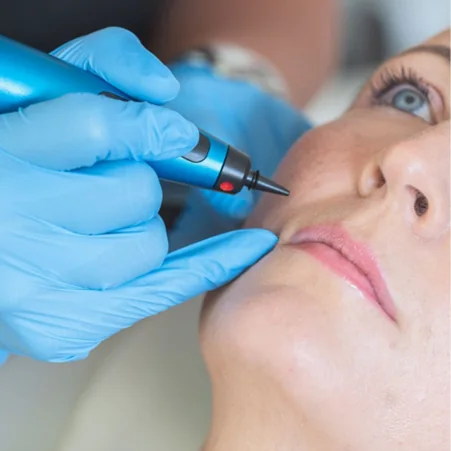 CryoPen skin tag removal close-up at Beauty Studio MediSpa, Shenfield