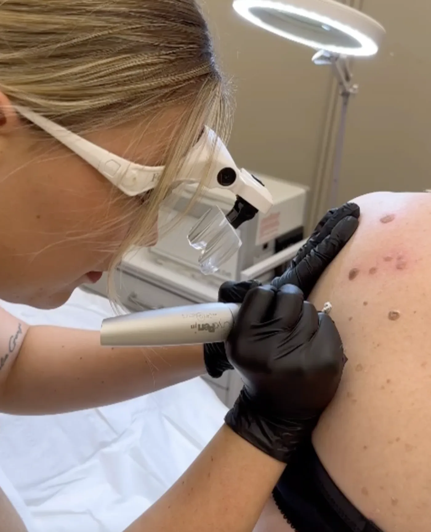 Cryopen for Skin Tags, Warts & Age Spots at Beauty Studio MediSpa, Shenfield