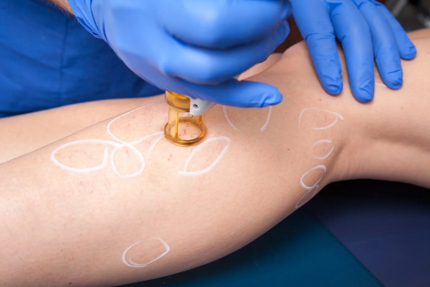 Cutera CoolGlide Veins at Beauty Studio MediSpa, Shenfield
