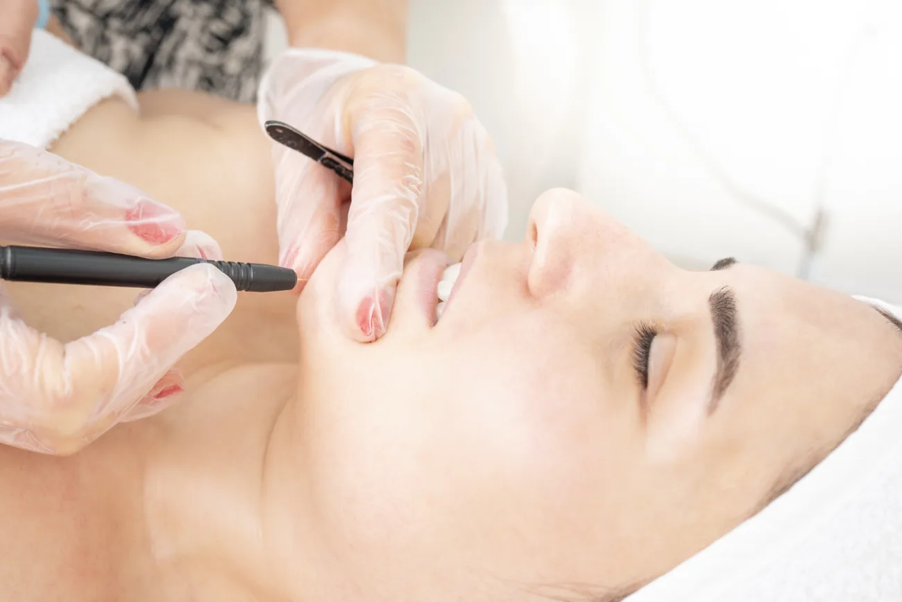 Electrolysis at Beauty Studio MediSpa, Shenfield
