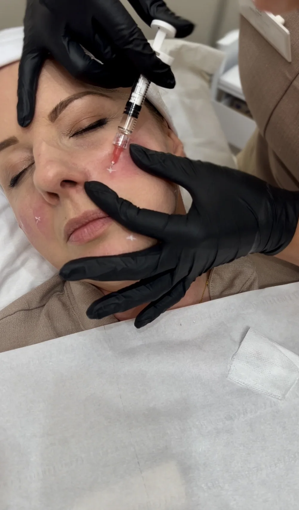 Profhilo at Beauty Studio MediSpa, Shenfield