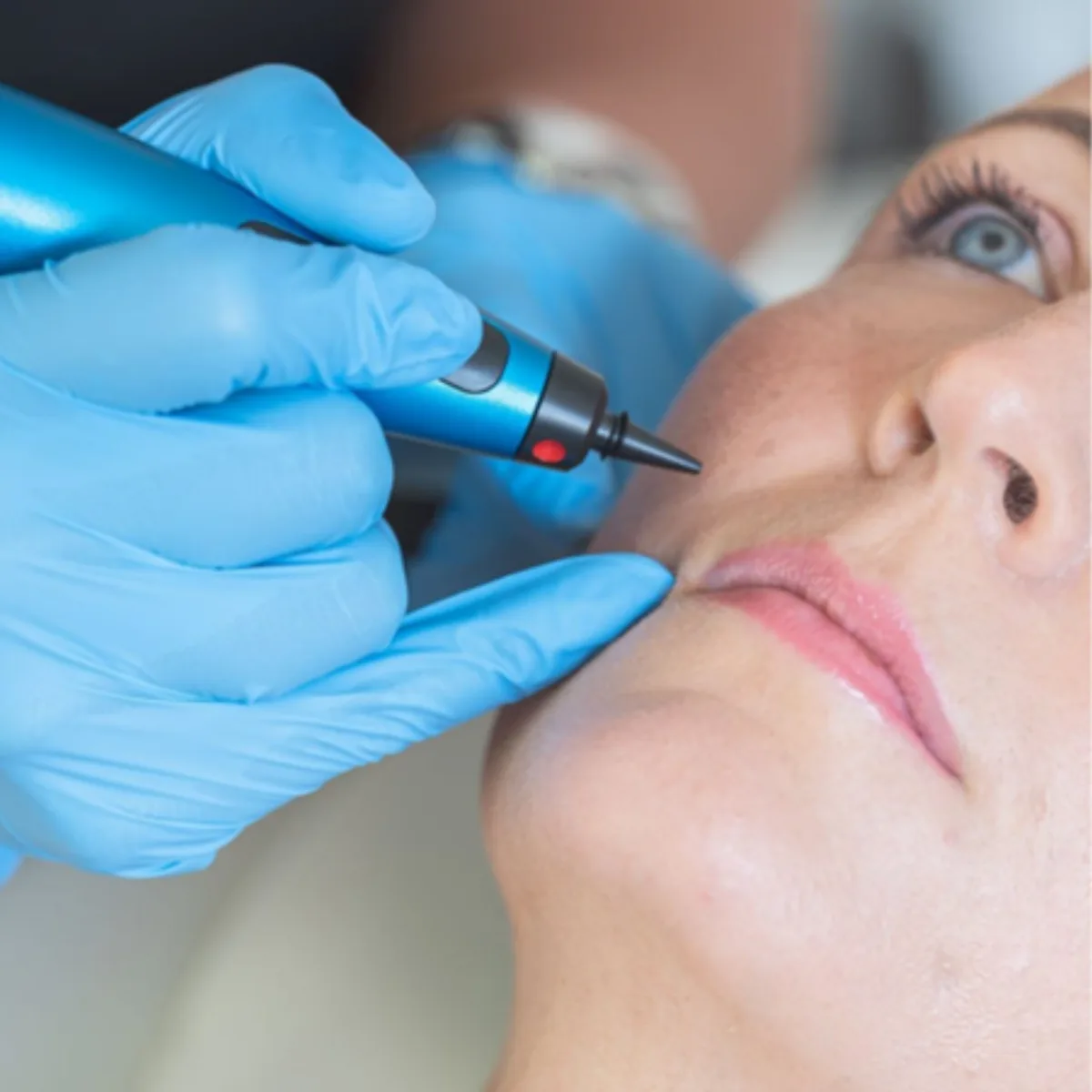 Skin Tags & Milia Removal at Beauty Studio MediSpa, Shenfield