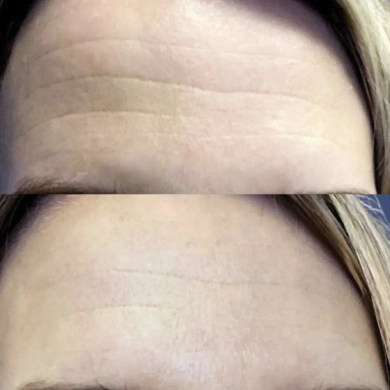 Sunekos injectable treatment at Beauty Studio MediSpa, Shenfield