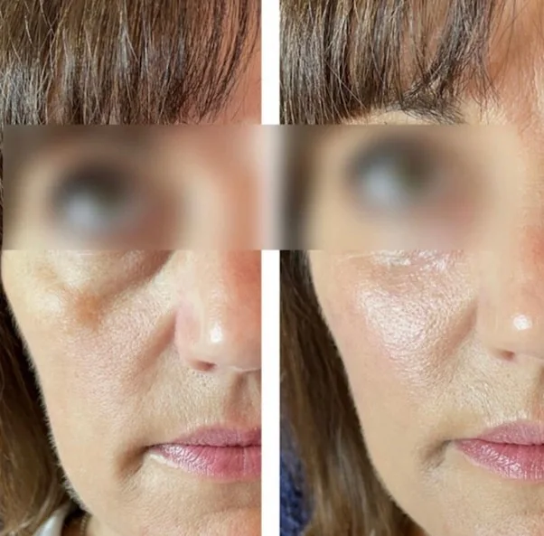 Sunekos under-eye treatment at Beauty Studio MediSpa, Shenfield