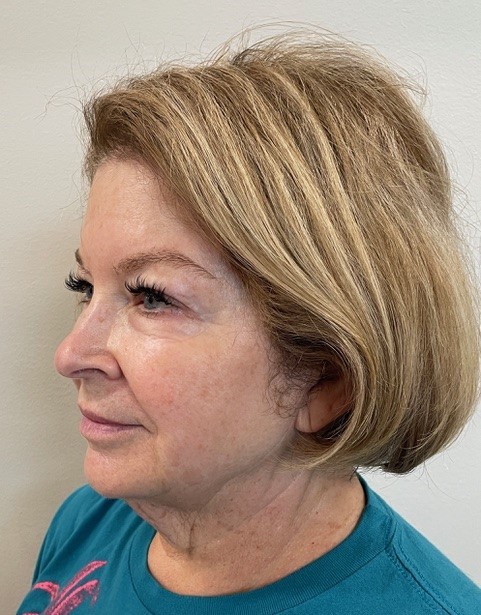 skinzonerx before set 1