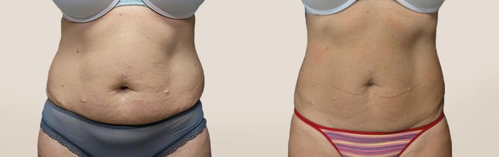 emsculpt pic ba card female abdomen 034 en100 (1)