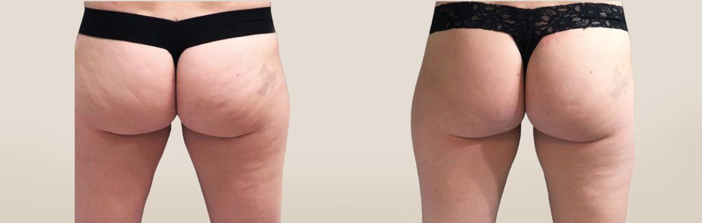 emsculpt pic ba card female buttock 092 for neo enus100