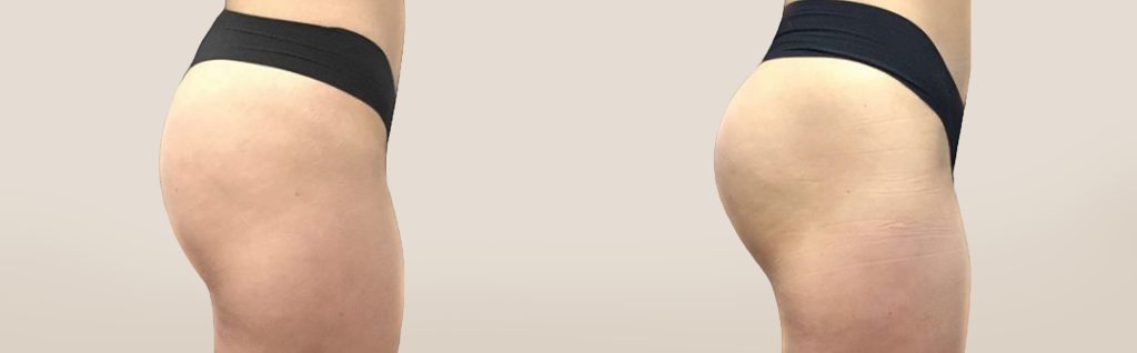 emsculpt pic ba card female buttock 094 for neo enus100