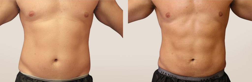 emsculpt pic ba card male abdomen 116 for neo enus100