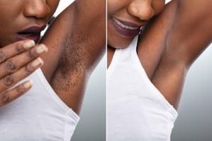 laser before after