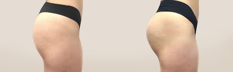 emsculpt pic ba card female buttock 094 for neo enus100