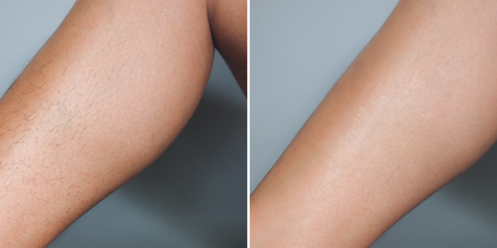 Legs before after