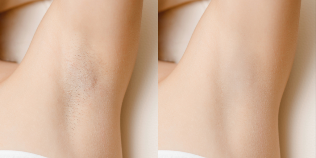 underarm before after