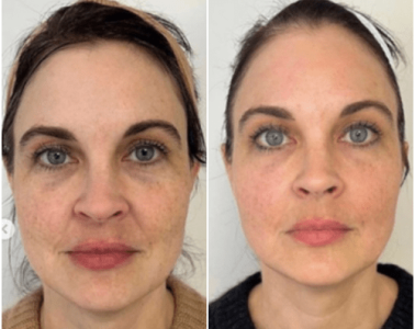 emface full face 5 1